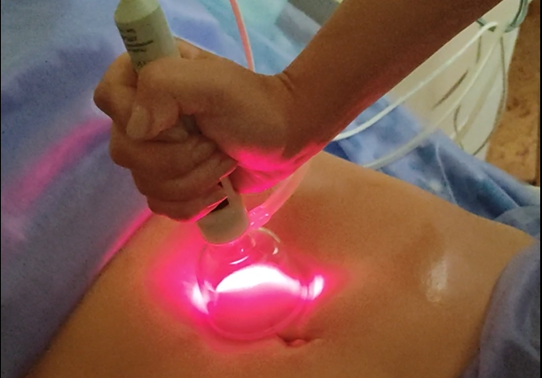 Лазерно-вакуумный массаж Лазмик - Аппаратный Висцеральный массаж при заболеваниях ЖКТ